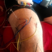 Knee treatment electro acupuncture