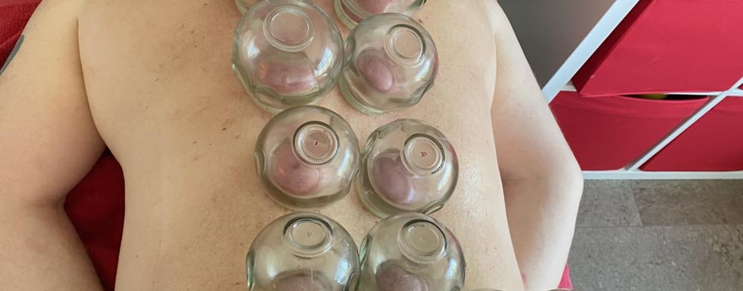 traditioinal chinese medical cupping